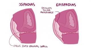 Hypospadias amp epispadias causes symptoms diagnosis treatment pathology [upl. by Aihcela]