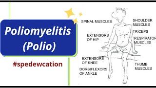 Poliomyelitis  Polio  Causes Symptoms Diagnosis Treatment Pathology Educational Implications [upl. by Onilegna]