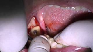 Alveolar ridge augmentation using onlay bone graft and bone splitting [upl. by Macy]