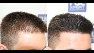 FUE Hair Transplant Repair 705 Grafts By Dr Juan Couto  FUEXPERT CLINIC Madrid Spain [upl. by Edrahs572]