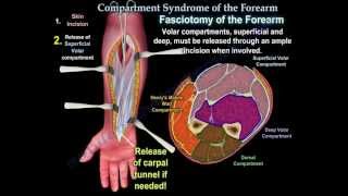 Compartment Syndrome Of The Forearm  Everything You Need To Know  Dr Nabil Ebraheim [upl. by Hartmann]