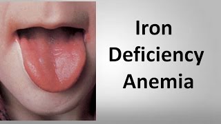 Iron Deficiency Anemia [upl. by Rennat]