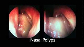 AAOHNSF The ENT Exam Episode 4 The Nasopharynx and Larynx Exam [upl. by Airt657]