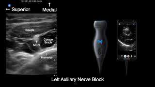 US anatomy for axillary nerve block with ButterflyIQ [upl. by Donahue]