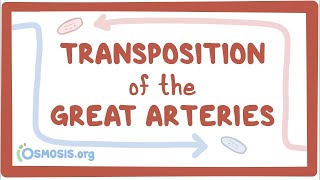 Transposition of the great arteries TGA  causes symptoms treatment amp pathology [upl. by Joly324]