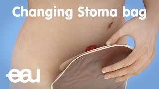 Changing stoma bag after bladder cancer treatment [upl. by Dorion]