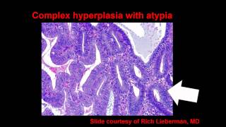 Topic 54 Endometrial Hyperplasia and Carcinoma [upl. by Thorstein]