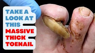 TAKE A LOOK AT THIS TOENAIL MASSIVE THICK TOENAIL [upl. by Eenolem]