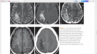 BRAIN IMAGING WITH MRI AND CT [upl. by Gaul872]