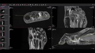 Neuromas vs Pseudoneuromas Case Example  RadPodSquad Plantar Plate Imaging [upl. by Nnylirret]