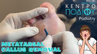 Callus RemovalΠοδολόγοςΠοδίατροςΚέντρο Ποδιού PodiatryPodiatrist κεντροποδιου calluses corn [upl. by Heller]