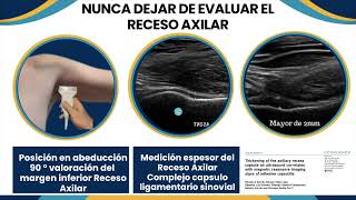 Como evaluar el hombro doloroso en capsulitis adhesiva Dr Guillermo Azulay [upl. by Aserehc]