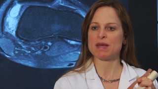 Dr Sabrina Strickland explains Patellar Dislocation and MPFL Reconstruction [upl. by Edison496]