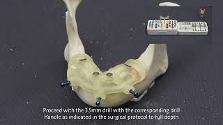 Straumann® Guided Surgery System and Straumann® BLT [upl. by Yesnel]