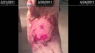 2nd Degree burns on foot  healing time lapse  2 months [upl. by Eelitan]