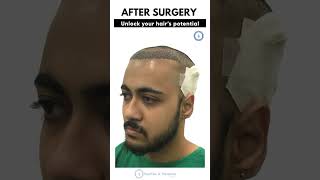 Best Hair Transplant Result In Kolkata  hairfreeandhairgrow [upl. by Egduj]