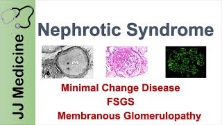 Nephrotic Syndrome  Clinical Presentation Causes and Treatment [upl. by Bartolome871]