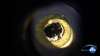 SimulEYE YAG Capsulotomy [upl. by Anoik]