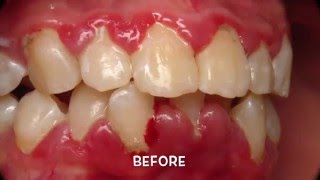 Reverse Periodontal Disease Periodontal Disease Treatment at Home [upl. by Lonni]