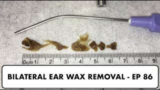 BILATERAL EAR WAX REMOVAL  EP 86 [upl. by Hakim24]