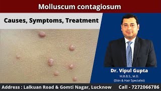 Molluscum contagiosum  Causes Symptoms Treatment [upl. by Wenger]