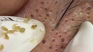 Removal Hidden Blackheads At Loan Nguyen Spa  30 [upl. by Anatlus]