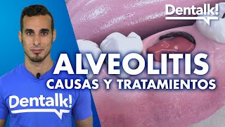 INFECCIÓN tras extracción dental ALVEOLITIS – Tratamiento síntomas y causas  Dentalk © [upl. by Ahmed]