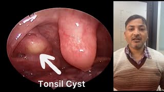 Right Tonsil Cyst  गले में दर्द और टीस का कारण [upl. by Adaminah]