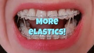 How I put my Braces Elastics on [upl. by Irme346]