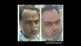 UVB Therapy for Vitiligo  Radiation Treatment Vitiligo Skin in Valsad Bardoli Surat [upl. by Aidaas557]