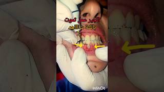 جير اسنان سبب التهاب اللثه وخلخلة الاسنان علاج في عيادة طبيب الاسنان dentist اكسبلور stitch [upl. by Ennaylime]