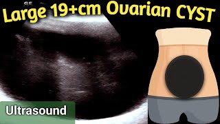 Ultrasound 19 cm Large Ovarian Cyst  equal to size of Handball in Abdomen [upl. by Garin]