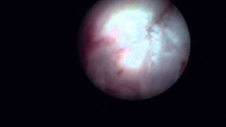 Arthroscopy of the Jaw Temporomandibular Joint TMJ  Part 1 [upl. by Fowkes]