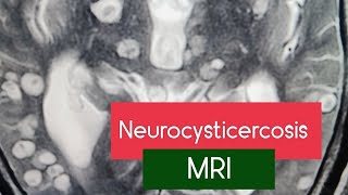 Neurocysticercosis On MRI SCAN  radiology mri learning neuroscience health brain [upl. by Eissirc208]