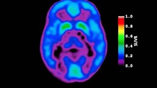 Video of AmyloidBeta Deposition in Autosomal Dominant Alzheimers Disease [upl. by Annala]