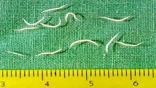 AWESOME TIPS  Pinworm Treatment In Adults  Cure Pinworm [upl. by Eeliah149]