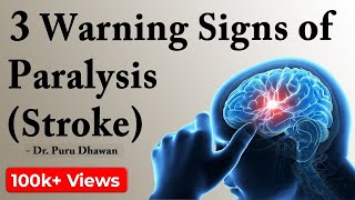 3 Warning Signs of Paralysis Stroke [upl. by Brasca]