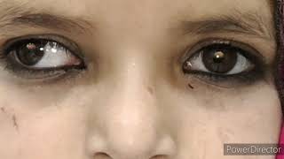 Intermittent exotropia decompensated [upl. by Isdnil]