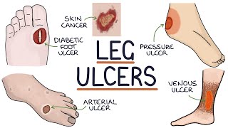 Understanding Leg and Foot Ulcers [upl. by Cimbura]