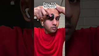 Day112 of Restoring Hairline [upl. by Hanna451]