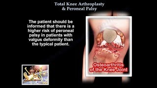 Total Knee Arthroplasty amp Peroneal Palsy  Everything You Need To Know  Dr Nabil Ebraheim [upl. by Tteltrab502]