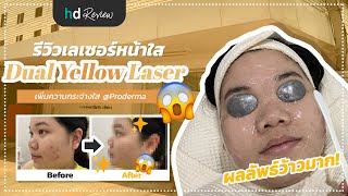 รีวิว Dual Yellow Laser ลดรอยแดงสิว ลดรอยดำสิว ที่ Proderma Aesthetic Clinics  HDreview [upl. by Ial]