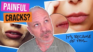 Why do I have CRACKED MOUTH CORNERS Angular Cheilitis  Dr Doug Willen [upl. by Eba]