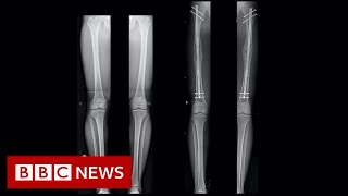 Leglengthening The people having surgery to be a bit taller  BBC News [upl. by Maharva]