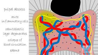 Acute Pulpitis  Diseases of Pulp Part 3 [upl. by Anetsirk]