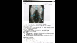 Radiology Achondroplasia [upl. by Grobe]