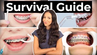 How To Prepare amp What To Expect With BRACES [upl. by Wivestad]