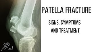 Patella fracture Mechanism of injury signs and symptoms and treatment [upl. by Sayers]