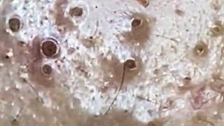 Blackheads amp Whiteheads Satisfying Removal 0113 [upl. by Assilaj272]