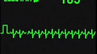 Supraventricular Tachycardia  SVT  ECG Simulator  Arrhythmia Simulator [upl. by Aihtela]